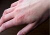 Сверблячий висип після перебування на холоді: це може бути тривожним сигналом