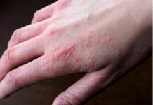 Сверблячий висип після перебування на холоді: це може бути тривожним сигналом